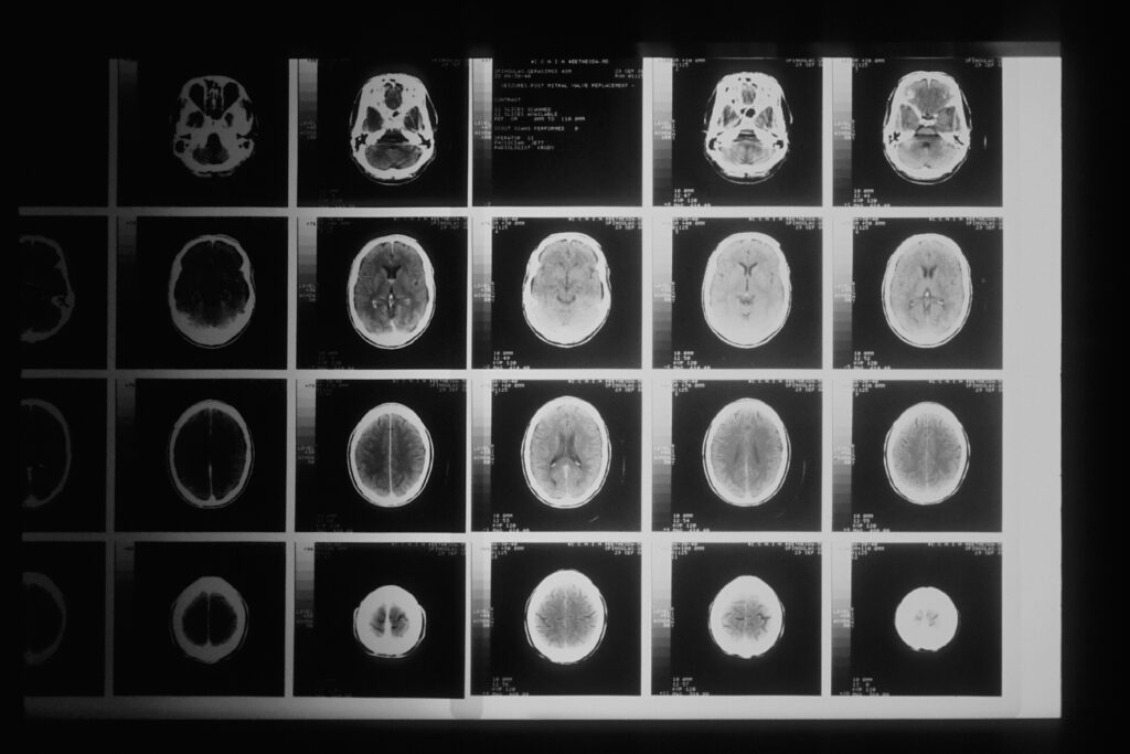 Black and white imaging scans of the brain.